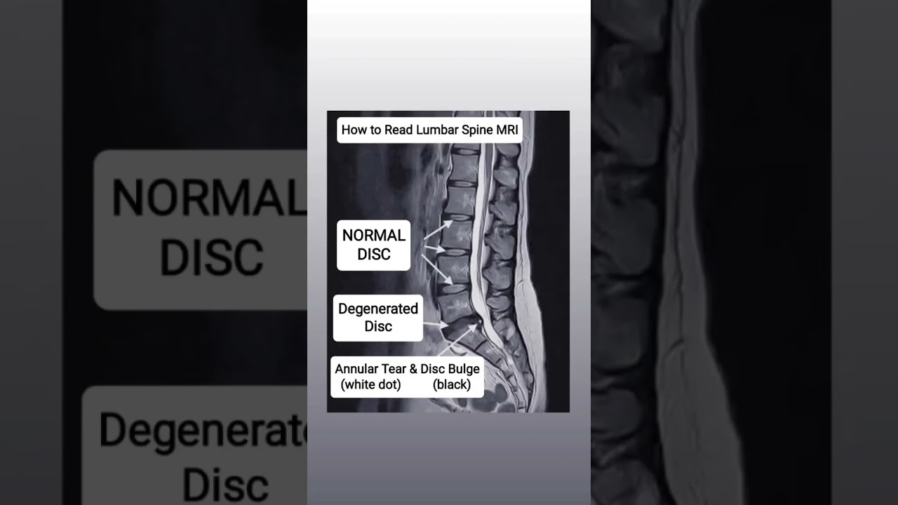 How to Read Lumbar Spine MRI 