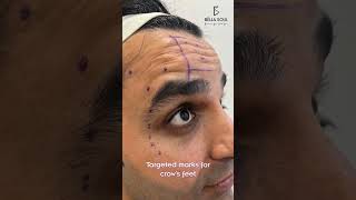 First-time Botox doesn’t have to feel overwhelming.