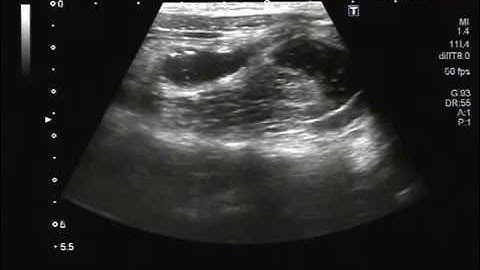 Ultrasound Video showing focusing of Faecolith in the inflamed Appendix.