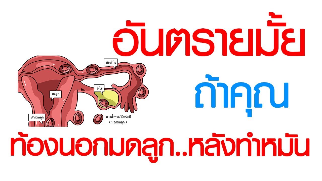 พบหมอเสรี ตอนที่ 120 : ท้องนอกมดลูก หลังทำหมัน