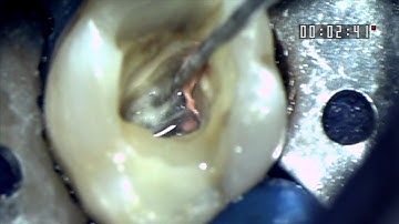 No initial scouting direct glide path