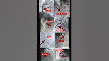 Thumbnail of एंजियोग्राफी से क्या क्या पता चलता है l Use of Angiography #shorts