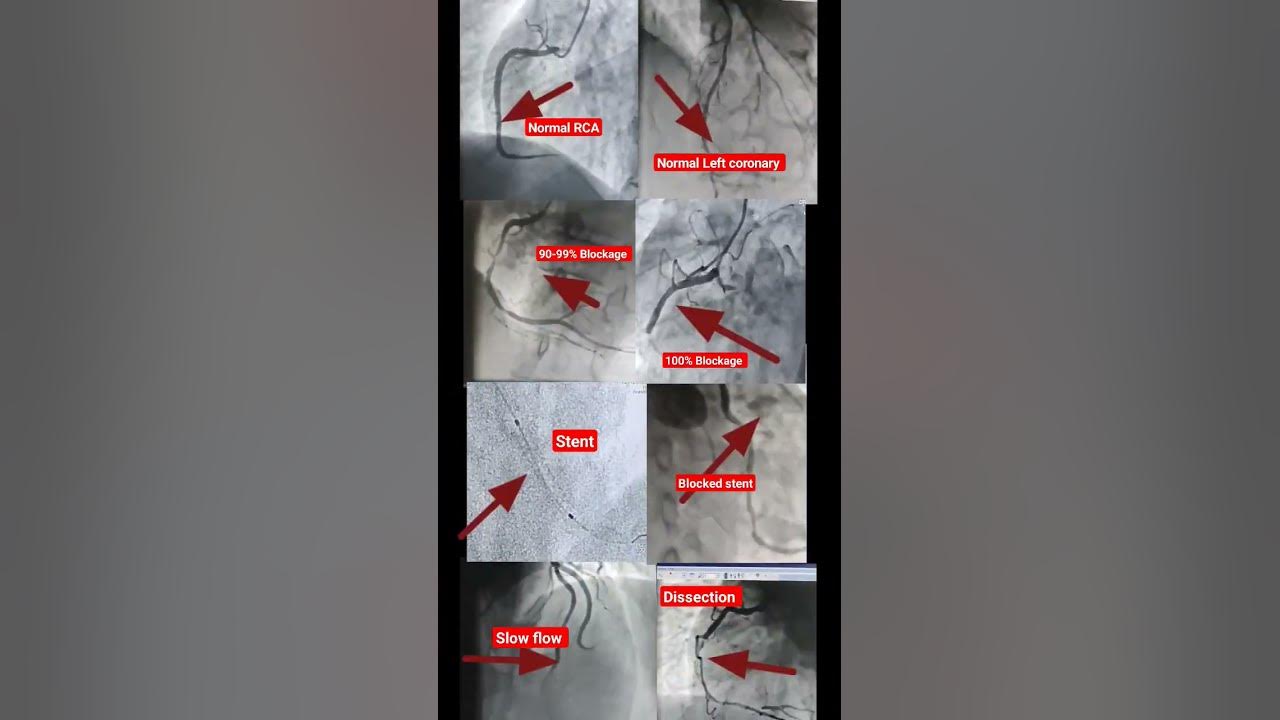 एंजियोग्राफी से क्या क्या पता चलता है l Use of Angiography #shorts