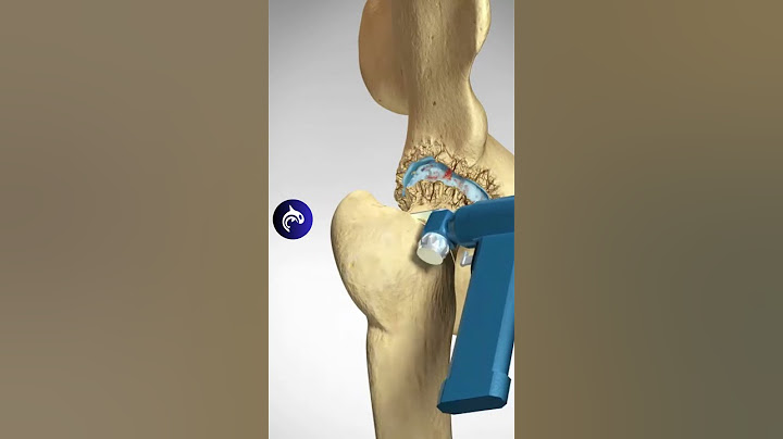 Total Hip Replacement (Arthroplasty) - 3D Animation