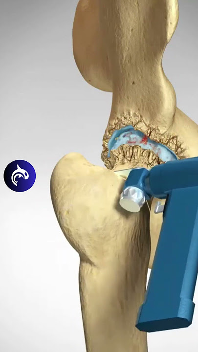 Total Hip Replacement (Arthroplasty) - 3D Animation