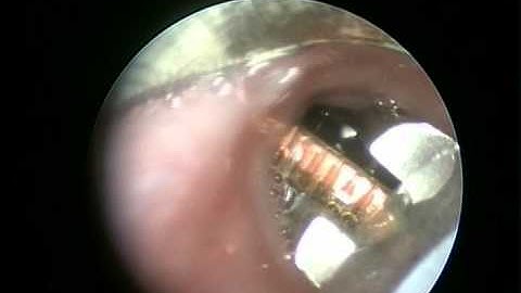 Esophageal coin - Stanford Children