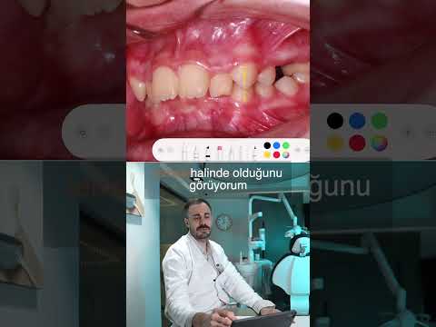 Vaka – 32 Plakta Gelen Gülüş: Çocukluk Dönemi Şeffaf Plak Tedavisi