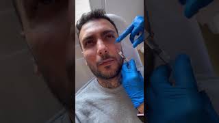 قبل و بعد از تزریق فیلر 💉 نتیجه طبیعی و متعادل