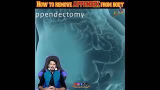 How to remove appendix #youtubeshorts #shorts @HaiderTvOfficial @MRINDIANHACKER @CrazyXYZ