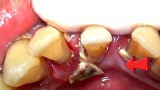 Scaling Karang Gigi Tebal | Tartar Removal |#017|@dentist_ruli