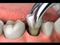 Extraccion dental: síntomas , medidas post-intervención y recomendaciones para el paciente