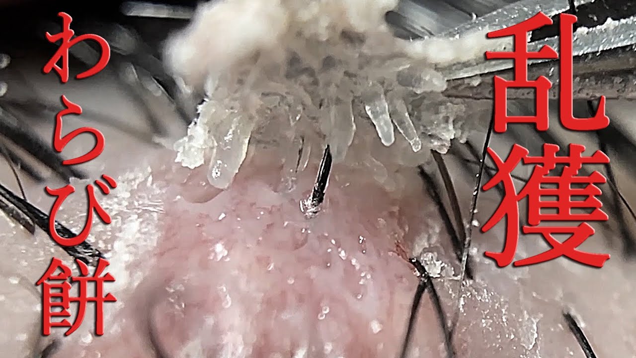 No.200 乱獲わらび餅。鬼かさぶた剥がし / Over-harvesting of the dermis attached to the scab / 過度採集附著於痂皮的真皮