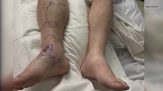 Rattlesnake bite in Oroville leaves Idaho man needing 54 vials of antivenom