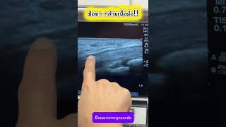 มือชา กล้ามเนื้อฝ่อ!!