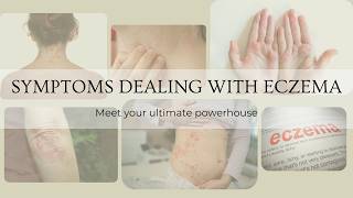 Skin eczema strikes? Meet your ultimate powerhouse