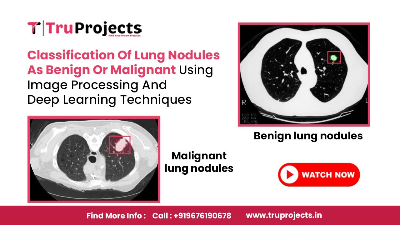 Classification Of Lung Nodules As Benign Or Malignant Using Image ...