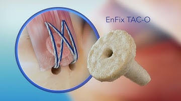 EnFix TAC™ Rotator Cuff Procedure