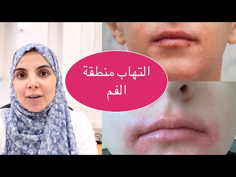 أسباب و علاج الاسمرار حول الفم