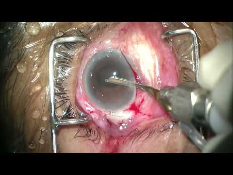 MSICS Ruit NS3+ iris prolapse 1 1