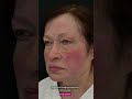 Блефаропластика до и после