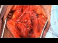 Anastomotic augmented urethroplasty with buccal mucosa graft