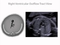 Right Ventricular Outflow Tract View of the Fetal Heart