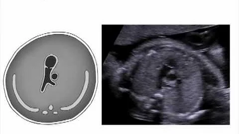 Right Ventricular Outflow Tract View of the Fetal ...
