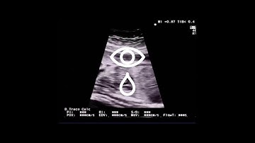 BONBA - Extrasistole