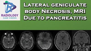 Lateral geniculate body Necrosis ,MRI  -  Due to pancreatitis