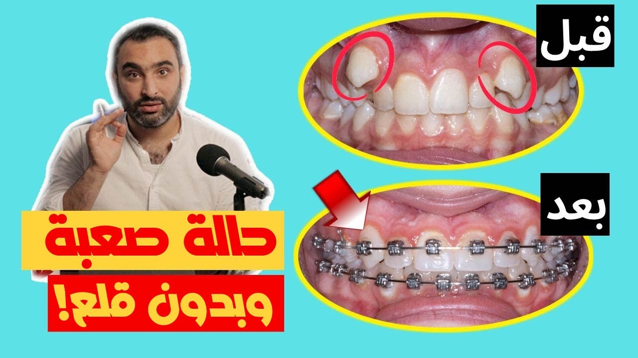 شاهد طريق معالجة بروز الأنياب و الفك العلوي وتراكب شديد بالاسنان وبدون قلع! | الدكتور محمدصادقلي