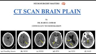 CT Scan Brain Plain -  Orientation, Anatomy and Pathologies - Part 1