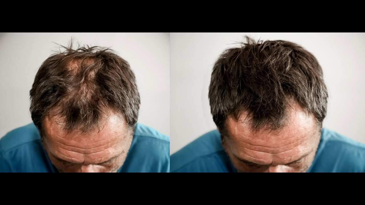 Perdita Caduta Capelli Diradati Cover Hair Italia Infoltimento Capelli