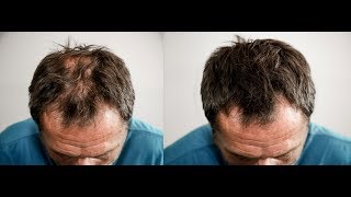 Perdita Caduta Capelli Diradati Cover Hair Italia Infoltimento Capelli