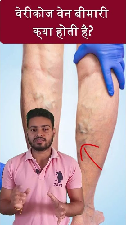 वेरीकोज वेन बीमारी क्या होती है?