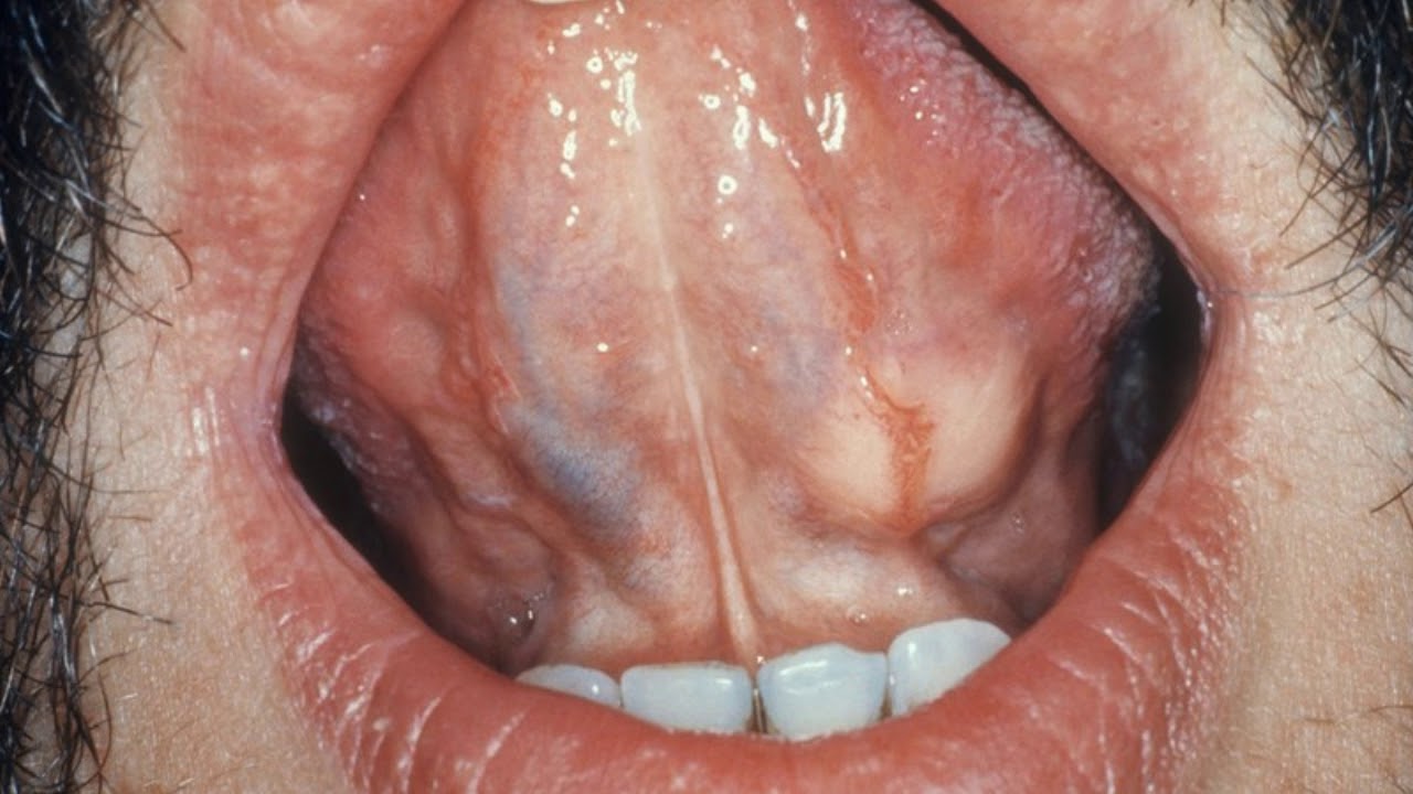 masterbation-throat-cancer-picture