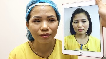 Kết Quả Cắt Mí Mani Open Deep 5D Vừa Thực Hiện Xong Tại Dr.Hải Lê.