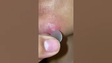 منتج ازاله حبوب الوجه خلال24ساعه 