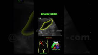 Sonography - Cholecystitis