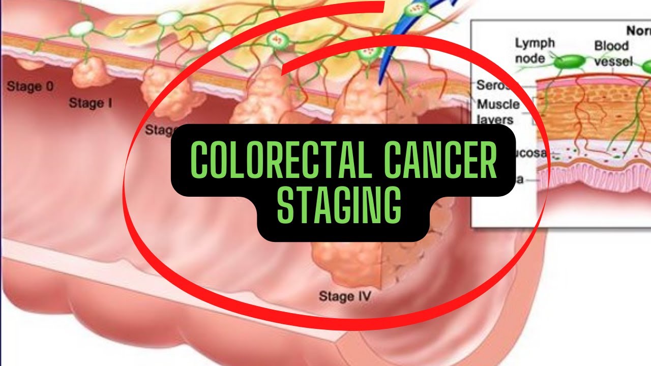 Colorectal Cancer | Dukes Classification + TNM Staging - YouTube
