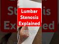 Lumbar stenosis explained #Laminectomy #Fusion #Spine #BackPain #SpineSurgeon #Neurosurgeon 