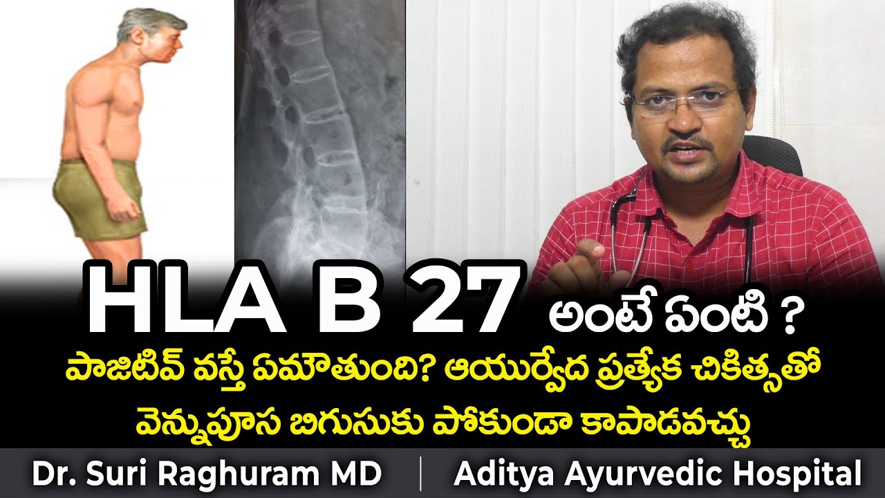 HLA B27 - AYURVEDIC TREATMENT - ANKYLOSING SPONDYLITIS - YouTube