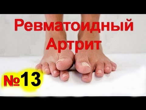 Ревматоидный артрит -