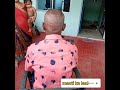 ड्रेसिंग Remove करने के बाद ट्रांसप्लांटेड हेयरCondition of Transplanted Hair After Dressing Remove