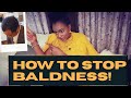 How to Stop Baldness | Natural Hair Tutorial