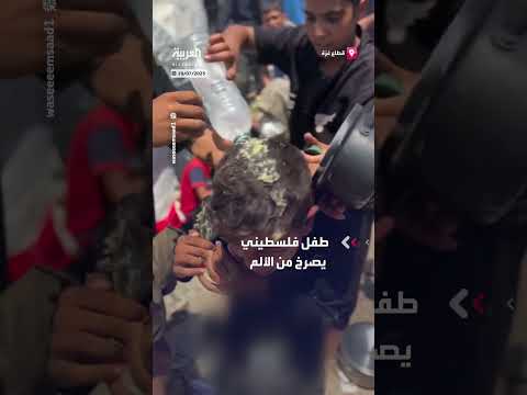طفل فلسطيني يتعرض لحروق إثر سقوط قدر ساخن عليه