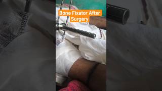 External Fixator Surgery & Recovery | External Fixator #shorts #externalfixatorsurgery&recovery
