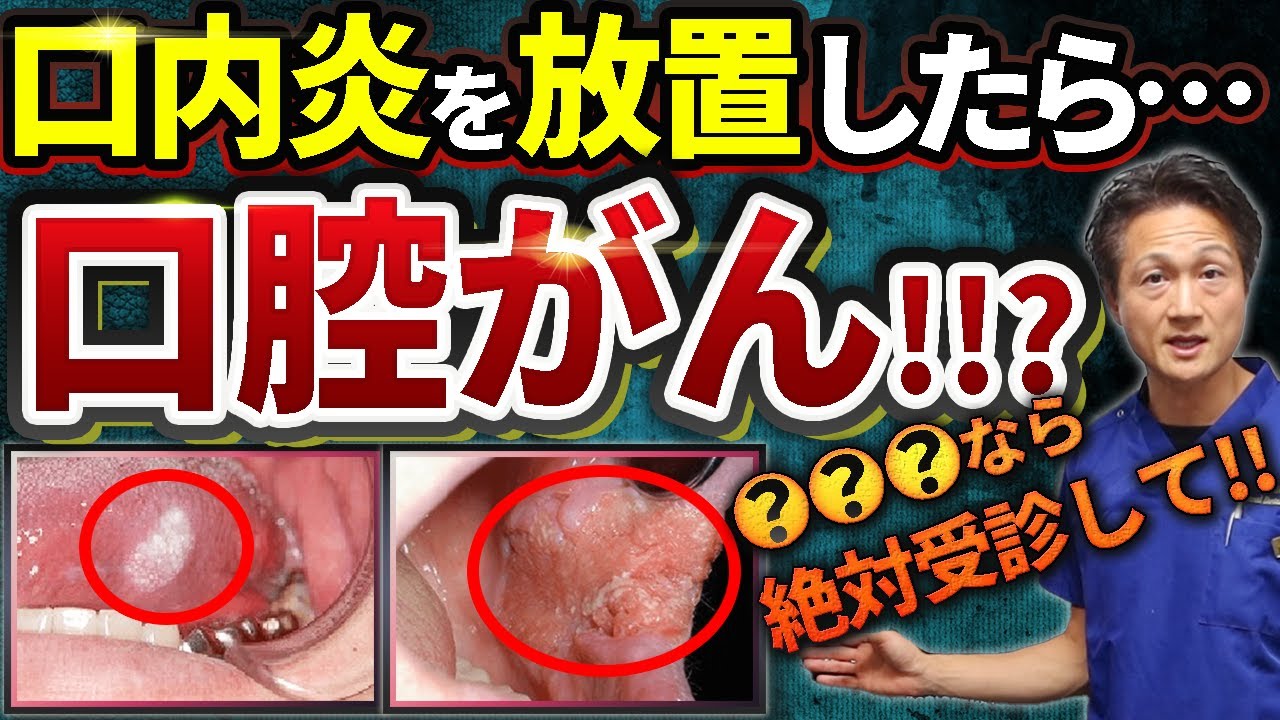 口内炎と口腔癌【要注意!異常から発症】初期症状と経過を歯医者が解説します!受診の目安,舌癌,痛み,しこり,腫れ,ただれ,出血 - YouTube