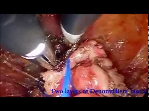 TaTME- Excision Of Denonvilliers’ Fascia In Anterior Rectal Tumours