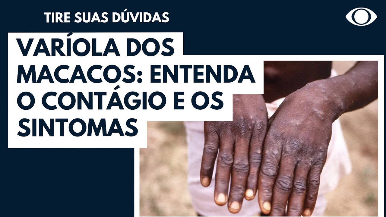 2° infectado por varíola dos macacos no Brasil, morador de Vinhedo