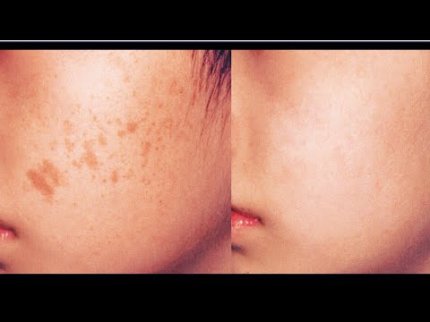 How to remove DARK SPOTS naturally | Get FLAWLESS skin
